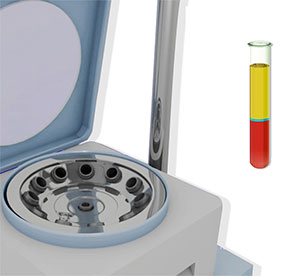 Platelet-Rich Plasma (PRP) Therapy for Hip Bursitis