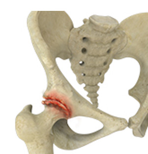 Osteoarthritis of the Hip