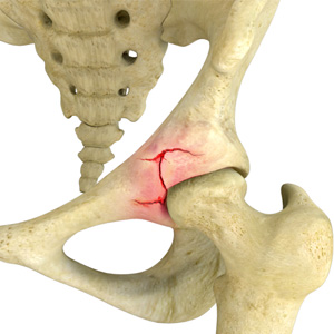 Hip Pain