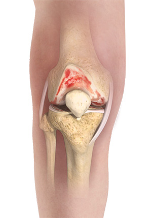 Osteoarthritis