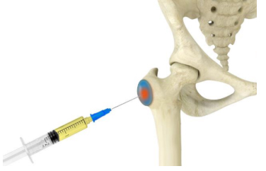 Platelet-Rich Plasma (PRP) Therapy for Hip Bursitis