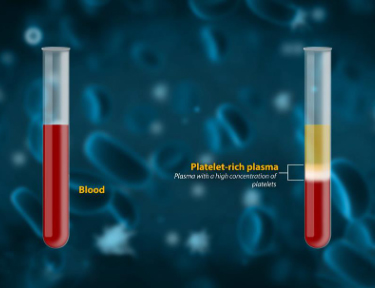 Platelet-Rich Plasma (PRP) Therapy for Hip Bursitis