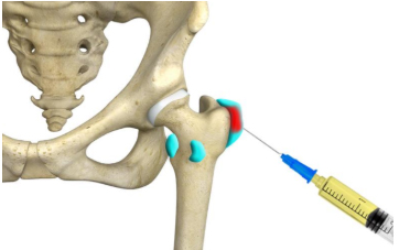 Platelet-Rich Plasma (PRP) Therapy for Hip Bursitis