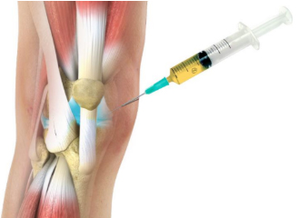 Platelet-Rich Plasma (PRP) Therapy for Knee Arthritis