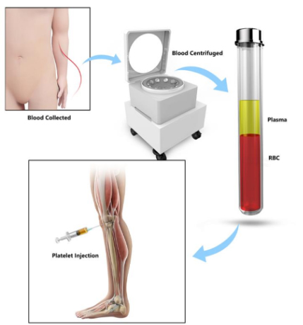 Platelet-Rich Plasma (PRP) Therapy for Knee Arthritis