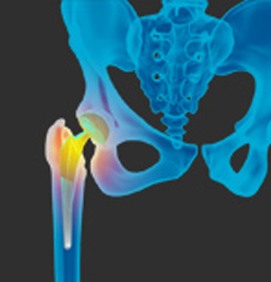 Revision Hip Replacement