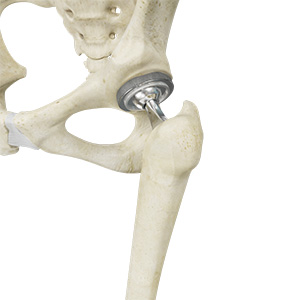 Tootal Hip Replacement