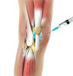 Viscosupplementation