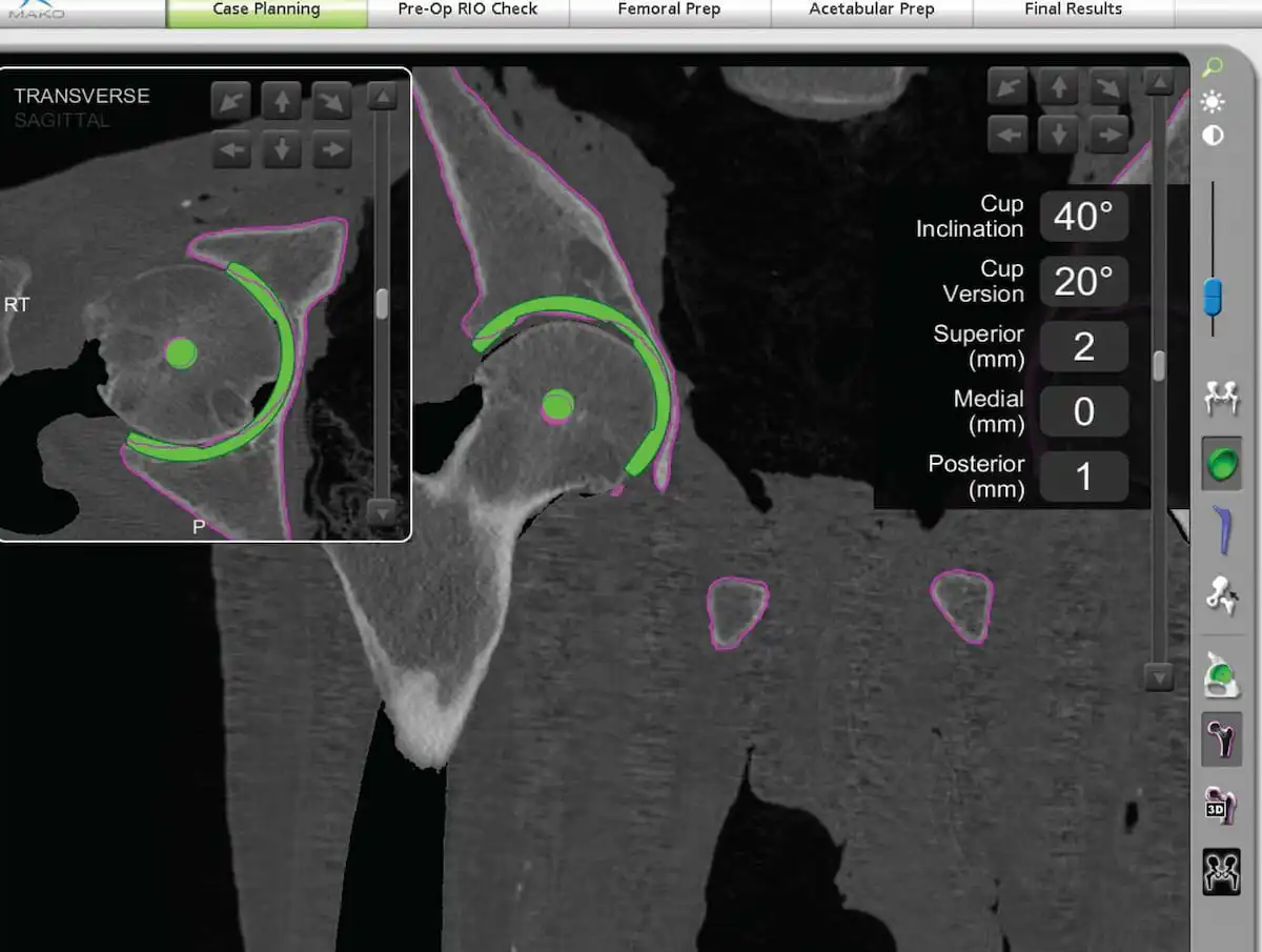 Mako robotic 3D hip CT scan surgical planning software personalized joint replacement